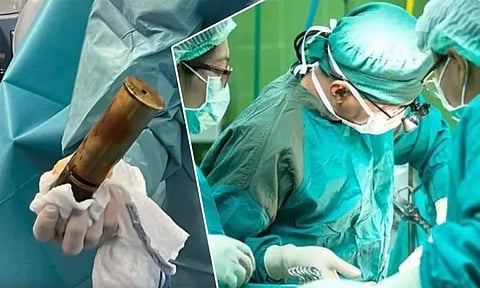 பாலியல் சுகத்திற்காக வெடிகுண்டை சொருகிய 88 வயது முதியவர்...! அதிர்ச்சியில் மருத்துவர்கள்