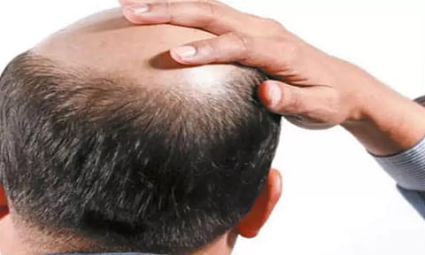 வழுக்கை தலை உடையவர்களுக்கு மாதம் ரூ.6 ஆயிரம் ஓய்வூதியம் வேண்டும் புதிதாக சங்கம் அமைத்து கோரிக்கை