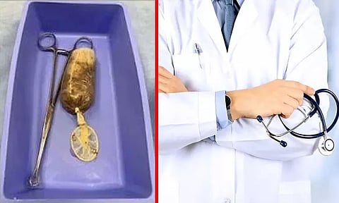 ஆணுறையில் வாழை பழம்... வாலிபர் செயலால் மருத்துவ உலகமே அதிர்ச்சி