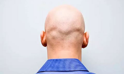 வழுக்கையால் வந்த அதிர்ஷ்டம்: வேலையை இழந்த நபருக்கு ரூ.70 லட்சம் நஷ்டஈடு வழங்க கோர்ட்டு உத்தரவு