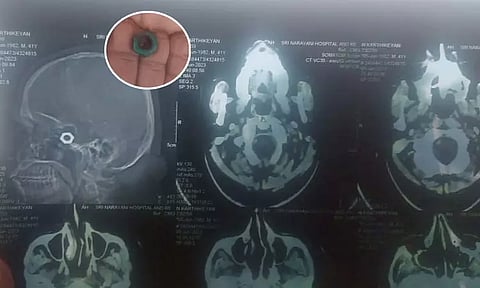 தலையில் இருந்த இரும்பு நட்டை அகற்றாமலே தையல் போட்ட செவிலியர்கள்...!