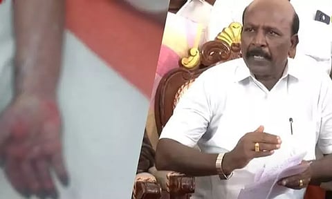 குழந்தையின் கை அழுகியதாக புகார்: மருத்துவமனையில் நடந்த சம்பவம் குறித்து அமைச்சர் விளக்கம்