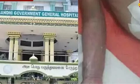 குழந்தையின் கை அகற்றப்பட்ட விவகாரம்: விசாரணைக்கு வர பெற்றோருக்கு மருத்துவக்குழு அழைப்பு