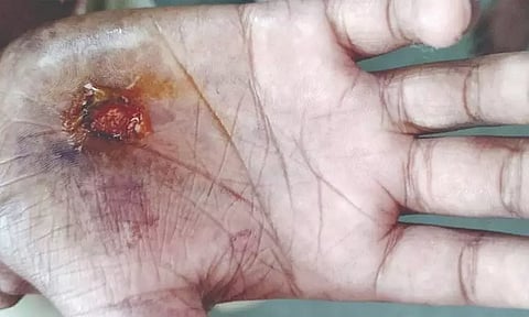 சிறுவர்கள் கடினமான வேலைகளில் ஈடுபடுவதால் கைகள் புண்ணாகும் நிலை