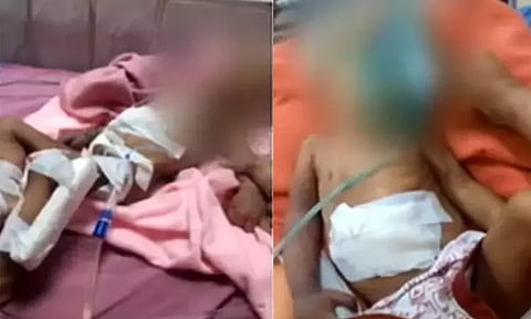 கை அகற்றப்பட்ட குழந்தை உயிரிழப்பு - அரசு மருத்துவமனை விளக்கம்