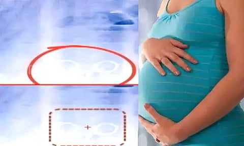 பிரசவத்திற்காக சென்ற பெண்ணின் வயிற்றில் கத்தரிகோலை வைத்து தைத்து அனுப்பிய மருத்துவர்கள்..!