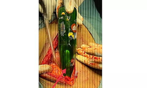 மாற்றுத்திறனாளி வயிற்றில் இருந்தகுளிர்பான பாட்டில்