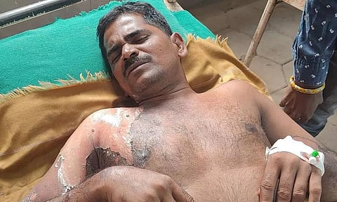 வெந்நீர் கொட்டியதில் தொழிலாளி படுகாயம்