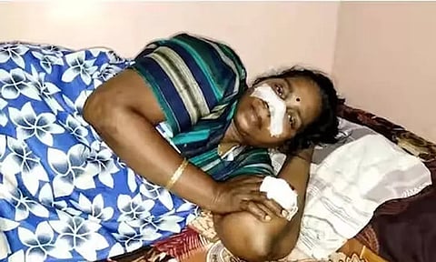 துக்க நிகழ்ச்சிக்கு வந்தபோது விபரீதம்: மனைவியின் மூக்கை அறுத்த கணவர்