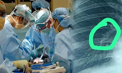 12 ஆண்டுகளாக பெண்ணின் நுரையீரலில் சிக்கியிருந்த மூக்குத்தி: நவீன அறுவை சிகிச்சை மூலம் அகற்றம்