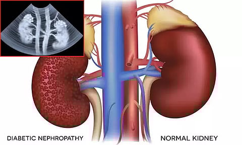 Diabetes and kidney disease