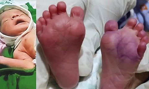 25 விரல்களுடன் பிறந்த அதிசய குழந்தை: ஆச்சரியத்தில் குடும்பத்தினர்