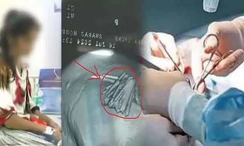 பெண்ணின் தலையில் 77 ஊசிகள்: காரணம் கேட்டு அதிர்ந்த டாக்டர்கள்