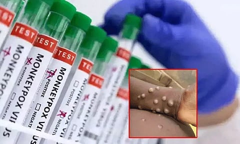 இந்தியாவில் ஒருவருக்கு குரங்கு அம்மை தொற்று அறிகுறி