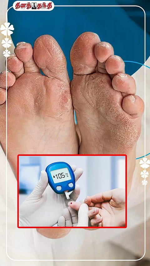 குளிர் காலத்தில் சர்க்கரை நோயாளிகளுக்கு தோல் பிரச்சினை ஏற்படுகிறதா?