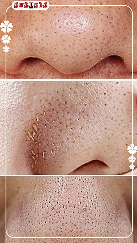 மூக்கை சுற்றியுள்ள கருமை மற்றும் வெள்ளை புள்ளிகளை தவிர்ப்பதற்கான வீட்டு குறிப்புகள்..!