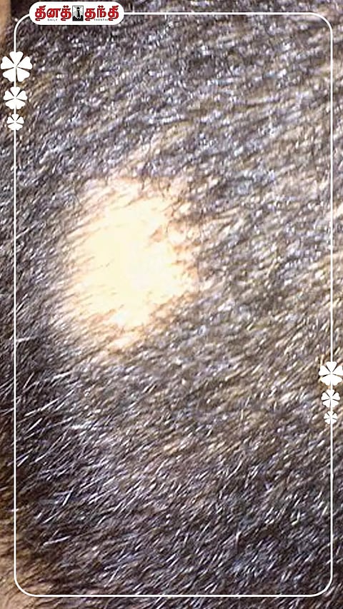 தலையில் பூச்சிவெட்டு, புழுவெட்டு ஏற்பட காரணம் தெரியுமா?