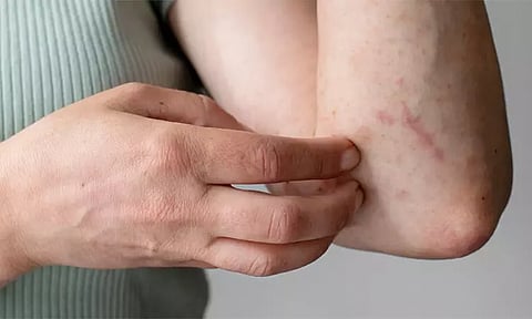 சர்க்கரை நோயாளிகள் உடலில் அரிப்பு ஏற்படாமல் தடுக்கும் வழிமுறைகள்