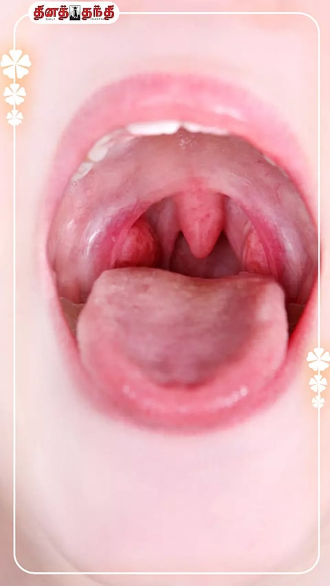 டான்சில் சுரப்பி என்றால் என்ன? அதன் பாதிப்பினால் ஏற்படும் விளைவு?