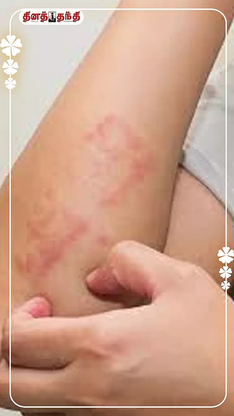 அரிப்பை ஏற்படுத்தி உடலை ரணமாக்கும் கரப்பான் நோய்..!