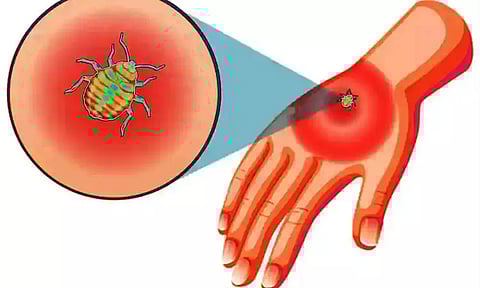 நகர மற்றும் கிராமப்பகுதிகளில் பரவி வரும் புதிய வகை பூச்சிக்கடி