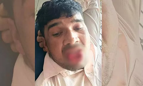 முத்தம் கொடுக்க முயன்ற கள்ளக்காதலனின் உதட்டை கடித்து துப்பிய இளம்பெண் - அதிர்ச்சி சம்பவம்