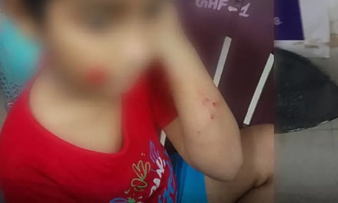 சென்னை போரூர் அருகே அதிர்ச்சி: டியூஷன் சென்ற சிறுவனை கடித்துக்குதறிய தெருநாய்