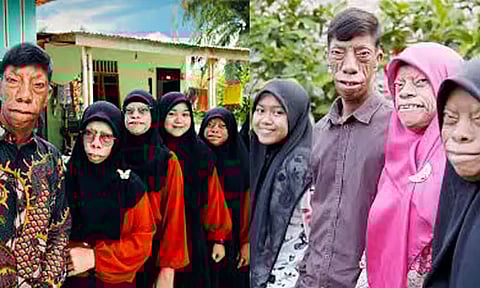 இந்தோனேசியா: அரிய நோயால் குடும்பமே பாதிப்பு; சமூக ஊடகம் வாயிலாக பிரபலம்