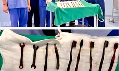 ராஜஸ்தானில் இளைஞரின் வயிற்றில் இருந்து இரும்பு ஸ்பேனர்கள் அகற்றம்