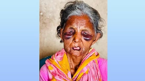 Boby Begum after being injured by the muggers
