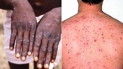 Monkeypox Virus Latest News