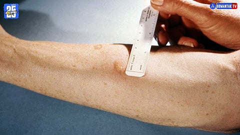 TB On Skin Symptoms