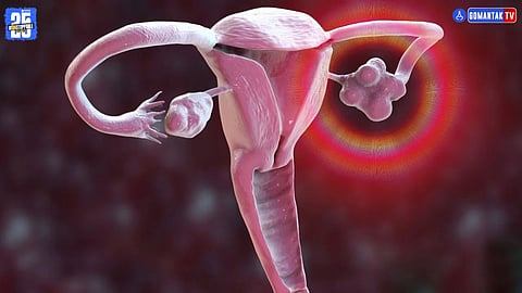 Polycystic Ovary Syndrome