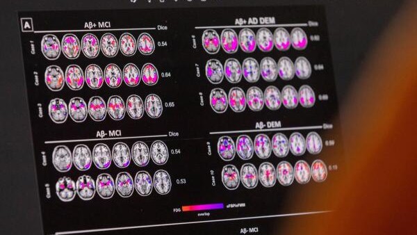 Healthcare reforms required globally to match progress in diagnosis, treatment of Alzheimer's disease: Researchers
