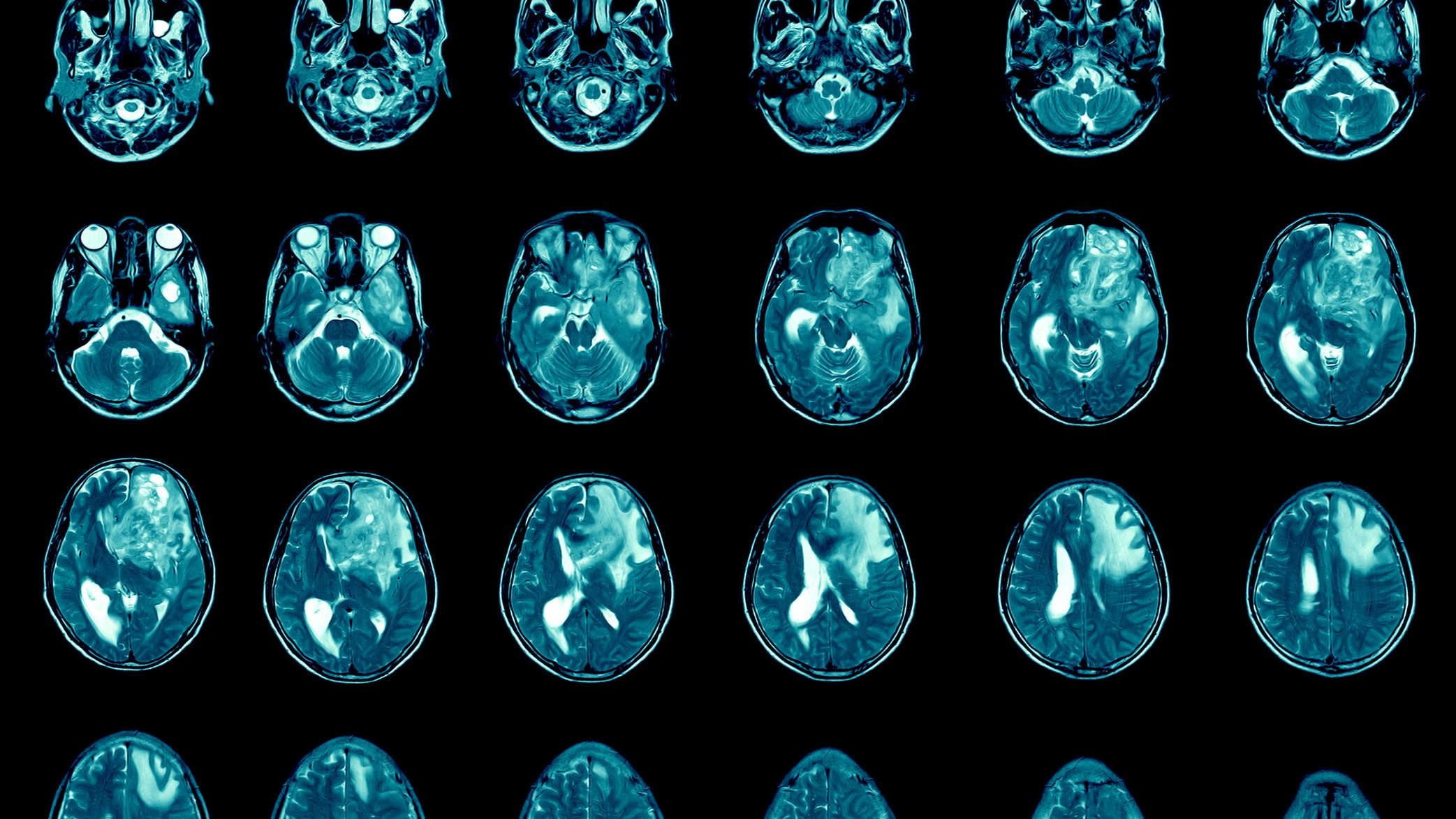 Glioblastoma: why immunotherapy may offer hope for brain cancer patients