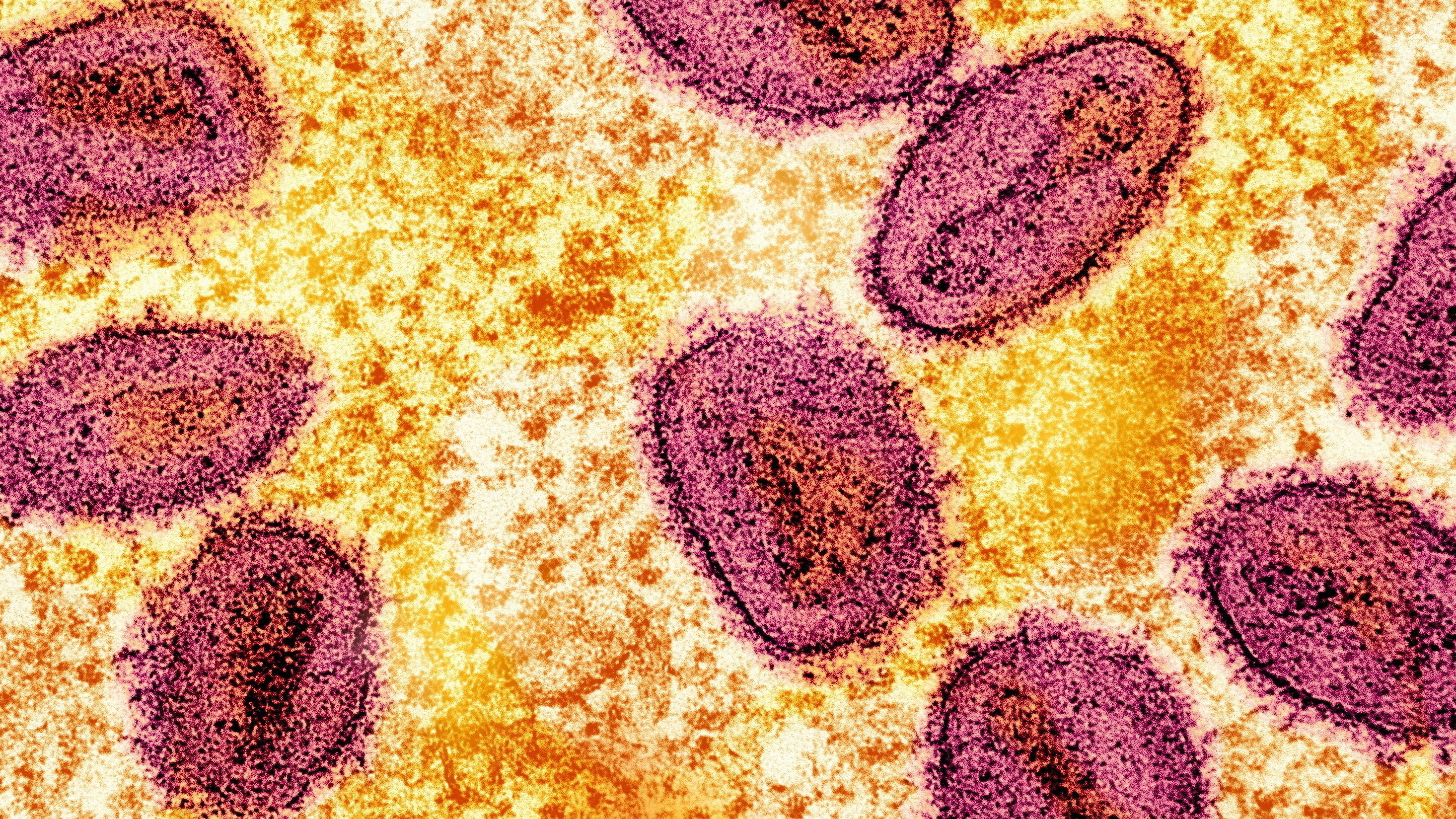 'Bleeding eye virus' kills 15 people in Rwanda. What is it and why are doctors worried?