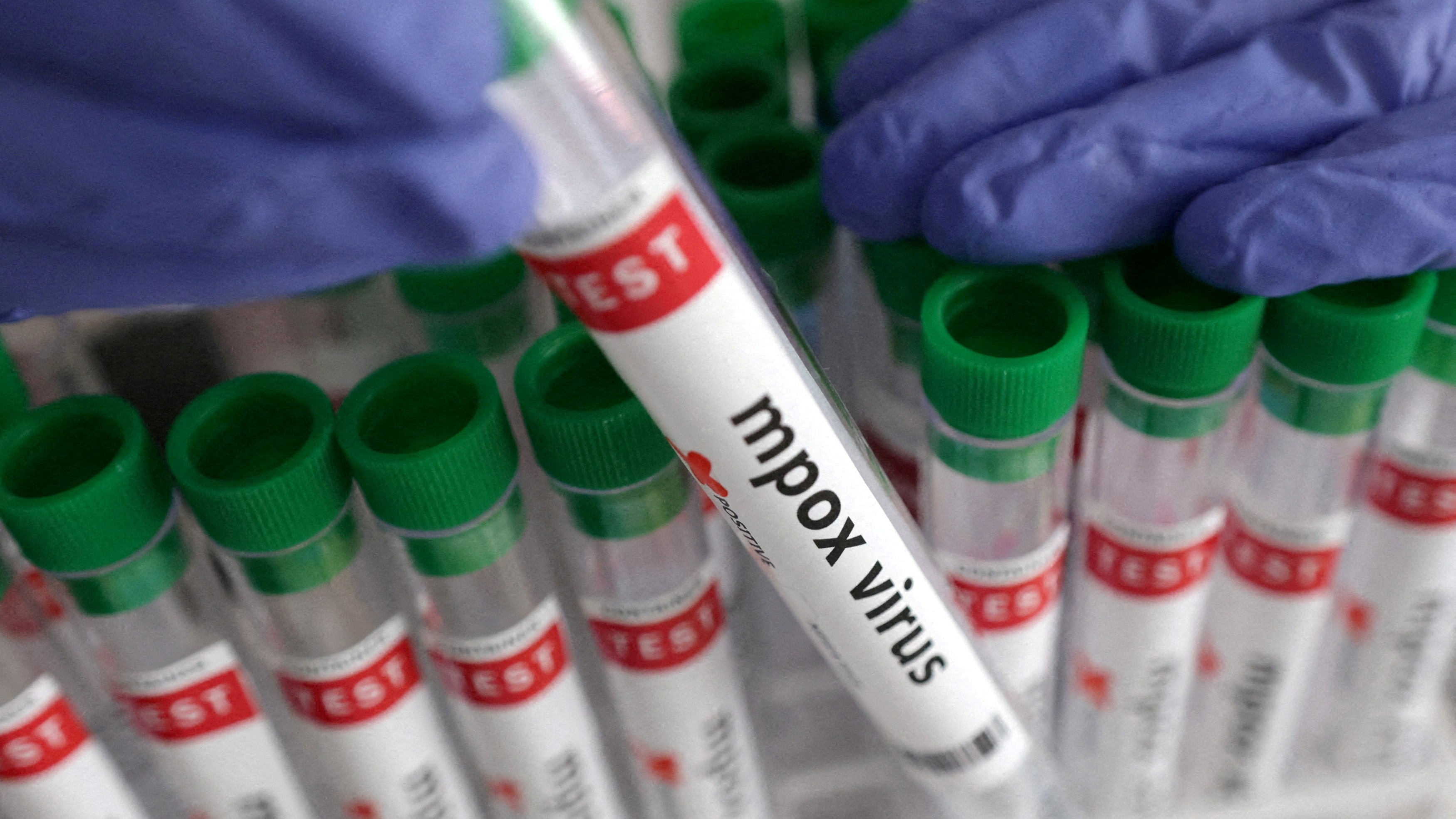 New case of mpox detected in England, risk to population ‘remains low’