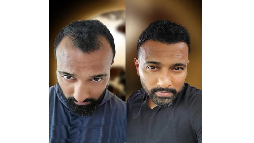 Hair Transplant Turkey: Is It Everything They Say It Is?