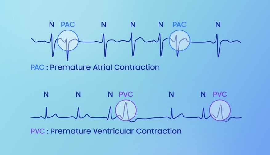 Galaxy Watch8 can detect Ectopic Beats.