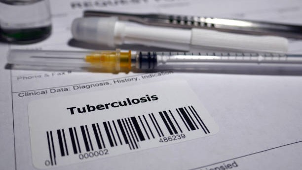 WHO report says India logged highest number of tuberculosis cases in 2024, drug-resistant cases show surge