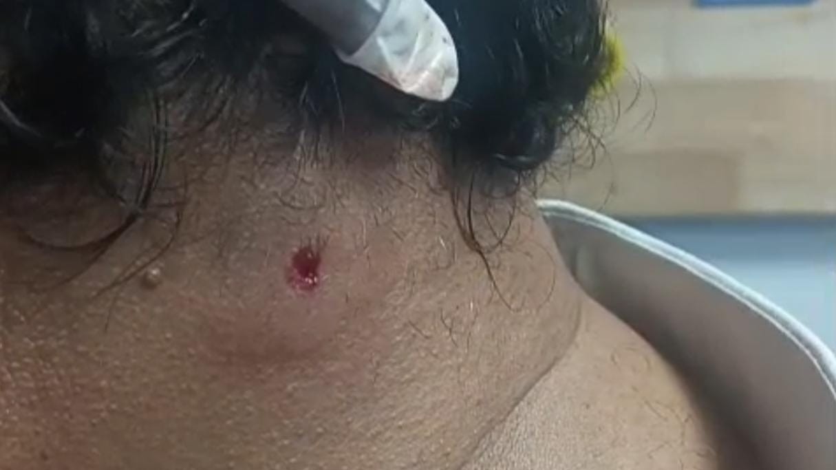 57-year-old businessman attacked by airgun pellet in Bengaluru