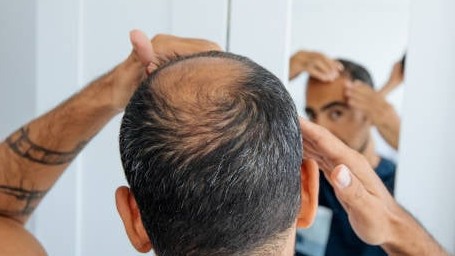 ‘Thick hair’ promise turns out to be false, Greater Noida wife lodges FIR against husband for hiding baldness