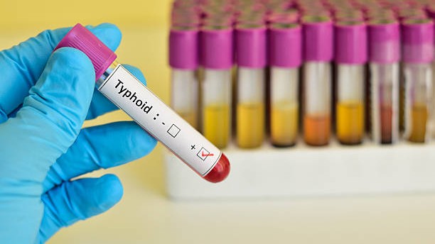 NHRC issues notice to Gujarat govt over typhoid outbreak, seeks detailed report in two weeks