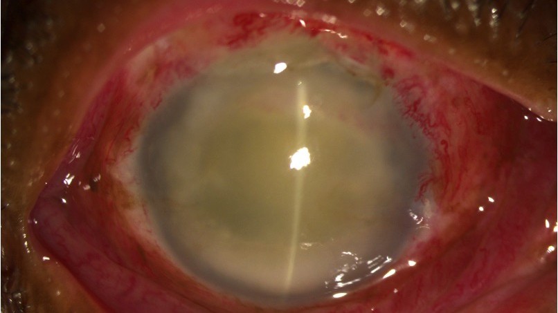 Antimicrobial resistance: CCMB-LVPEI study flags drug-resistant eye bugs