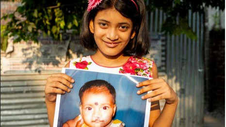 90% people feel more socially accepted post cleft surgeries 