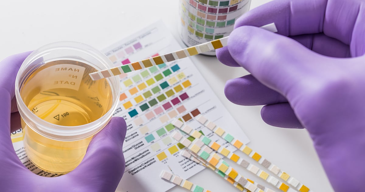 New Urine Test Kit Detects 92% of Bladder Cancer Cases