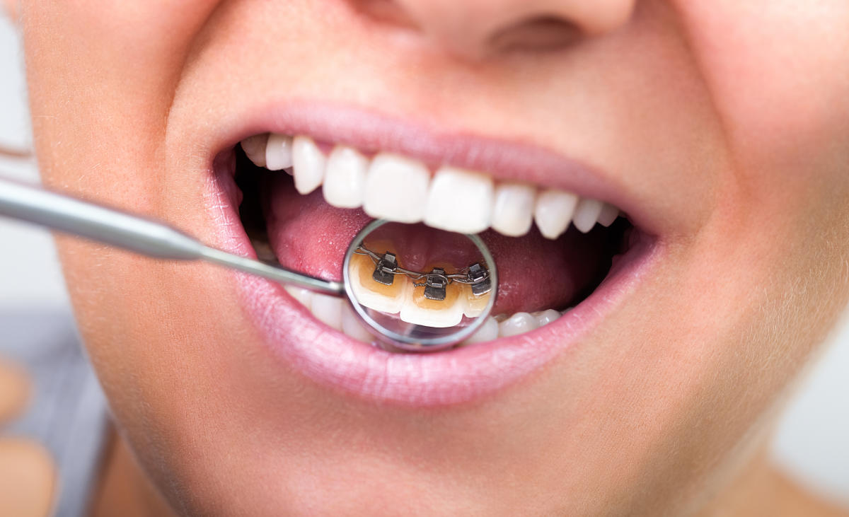 An invisible solution for a perfect smile  