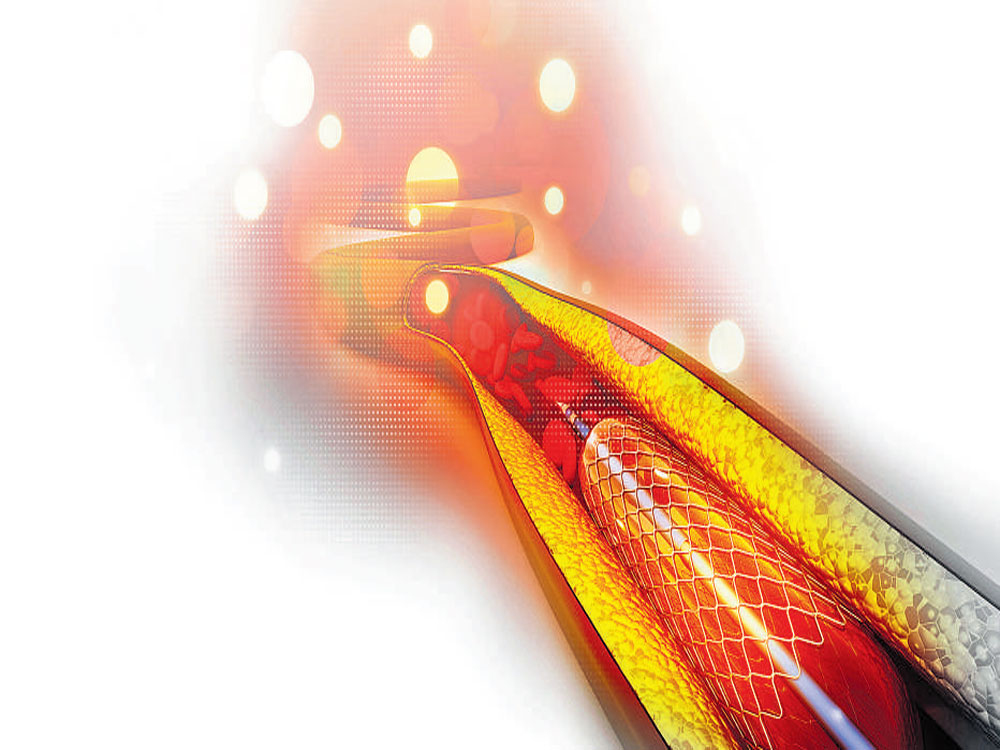 Stents: balancing price with quality