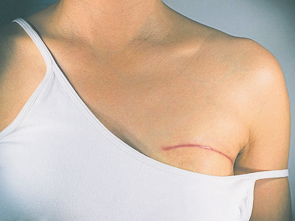 Eating processed meat may increase breast cancer risk