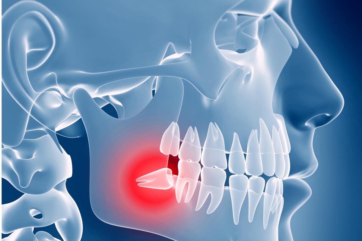 Doctors remove 526 Teeth from 7-year-old child